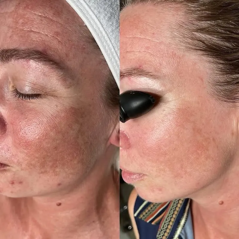 Anita's Skin Care Clinic | Facial and Acne Specialist at Katy — Facial spa in Katy